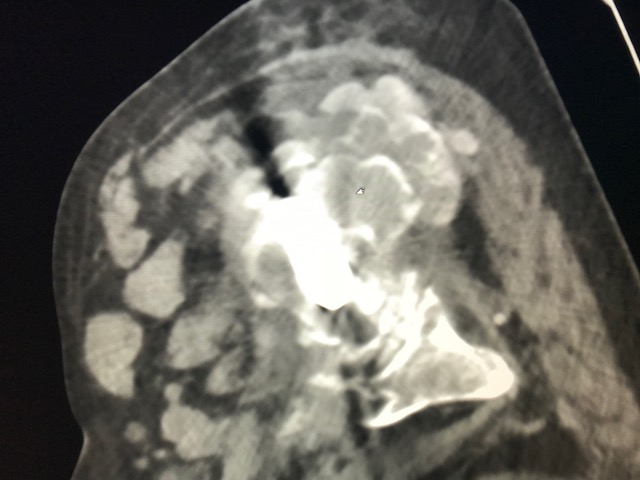 Figure 3 for case Tumoral calcinosis ( RID5202 )